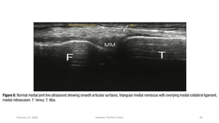 Who Responds to Genicular RFA in Knee OA? Ultrasound Synovial ...