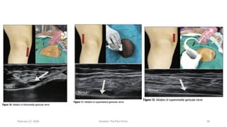 Who Responds to Genicular RFA in Knee OA? Ultrasound Synovial ...