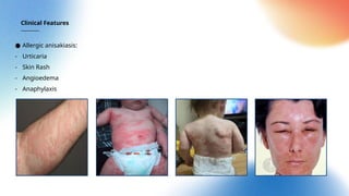 Anisakiasis: clinical, diagnosis, and treatment | PPTX