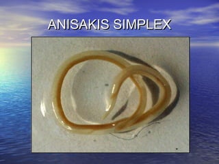 ANISAKIS SIMPLEX

 
