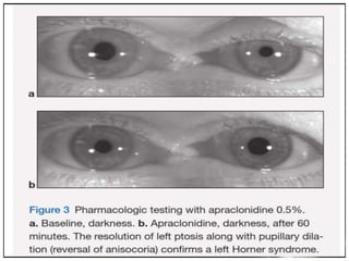 Anisocoria | PPTX