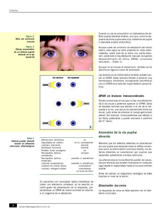 Anisocoria