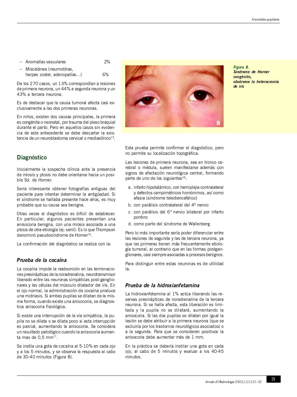 Anisocoria