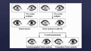 Physiological and Pathological anisocoria.pptx