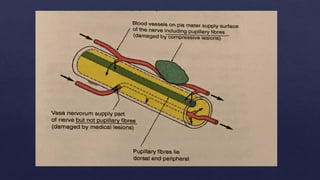 Physiological and Pathological anisocoria.pptx