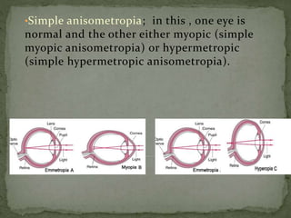 •Simple anisometropia; in this , one eye is
normal and the other either myopic (simple
myopic anisometropia) or hypermetropic
(simple hypermetropic anisometropia).
 