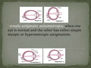 • simple astigmatic anisometropia; when one
eye is normal and the other has either simple
myopic or hypermetropic astigmatism.
 
