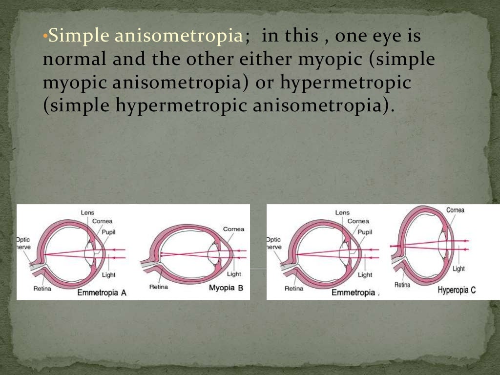 Anisometropia