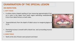 ON INSPECTION:
1. SOFT TISSUE
 A solitary dome shaped swelling of size measuring approximately 0.5x1
cm is seen in the upper front tooth region extending mediolaterally
0.5cm from labial frenum on both sides.
 Superoinferiorly from the depth of labial sulcus to marginal gingiva of
11,21
 Overlying mucosa is smooth with a bluish hue and surrounding mucosa
is normal
2. HARD TISSUE
 Teeth at the site of lesion were present and intact
EXAMINATION OF THE SPECIAL LESION
 