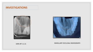 INVESTIGATIONS
IOPA IRT 11 21 MAXILLARY OCCLUSAL RADIOGRAPH
 