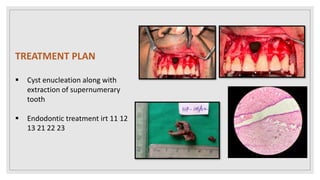 TREATMENT PLAN
 Cyst enucleation along with
extraction of supernumerary
tooth
 Endodontic treatment irt 11 12
13 21 22 23
 