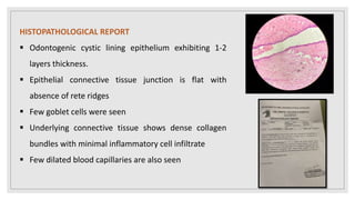 HISTOPATHOLOGICAL REPORT
 Odontogenic cystic lining epithelium exhibiting 1-2
layers thickness.
 Epithelial connective tissue junction is flat with
absence of rete ridges
 Few goblet cells were seen
 Underlying connective tissue shows dense collagen
bundles with minimal inflammatory cell infiltrate
 Few dilated blood capillaries are also seen
 