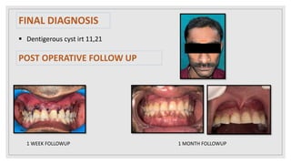 FINAL DIAGNOSIS
 Dentigerous cyst irt 11,21
POST OPERATIVE FOLLOW UP
1 WEEK FOLLOWUP 1 MONTH FOLLOWUP
 