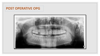 POST OPERATIVE OPG
 