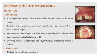 EXAMINATION OF THE SPECIAL LESION:
INSPECTION:
1. SOFT TISSUE
 A solitary diffuse swelling of size approximately 1x1cm is present on the palatal
region.
 Extending antero-posteriorly from incisive papilla region to posteriorly 2mm in
front of palatal rugae
 Mediolaterally towards right side 1mm away from mid-palatal raphe to 2mm
away from marginal palatal gingiva of 13
 Overlying mucosa is edematous and erythematous, surrounding mucosa is
normal
2. HARD TISSUE
 Tooth at the site of lesion was absent
 