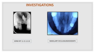 INVESTIGATIONS
IOPAR IRT 11 21 12 22 MAXILLARY OCCLUSALRADIOGRAPH
 