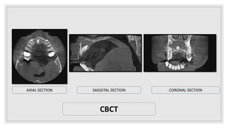 AXIAL SECTION SAGGITAL SECTION CORONAL SECTION
CBCT
 