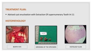 TREATMENT PLAN:
 Advised cyst enucleation with Extraction Of supernumerary Tooth Irt 11
HISTOPATHOLOGY
GROSSING OF THE SPECIMEN HISTOLOGY SLIDE
BIOPSY SITE
 