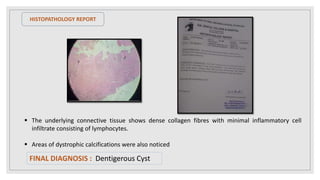 HISTOPATHOLOGY REPORT
 The underlying connective tissue shows dense collagen fibres with minimal inflammatory cell
infiltrate consisting of lymphocytes.
 Areas of dystrophic calcifications were also noticed
FINAL DIAGNOSIS : Dentigerous Cyst
 