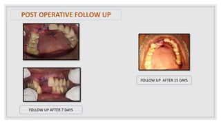 FOLLOW UP AFTER 7 DAYS
FOLLOW UP AFTER 15 DAYS
POST OPERATIVE FOLLOW UP
 