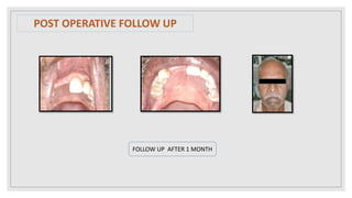 POST OPERATIVE FOLLOW UP
FOLLOW UP AFTER 1 MONTH
 