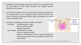  Dentigerous cyst develops around the crown of an unerupted tooth
by accumulation of fluid either between the reduced enamel
epithelium and enamel
 This fluid accumulation occurs as a result of the pressure exerted by
an erupting tooth on an impacted follicle, which obstructs the
venous outflow and thereby induces rapid transudation of serum
across the capillary wall.
 Two types of dentigerous cysts occur( Ben and Altini)
First type - Developmental in origin,
Occurs in mature teeth
Result of impaction
Second type - Inflammatory in origin
Occurs in immature teeth
Result of inflammation from a non-vital deciduous
tooth or some other source spreading to involve the
tooth follicle
Önay Ö, Süslü AE, Yılmaz T. Huge dentigerous cyst in the maxillary sinus: a rare case in childhood. Turkish archives of otorhinolaryngology. 2019 Mar;57(1):54.
 