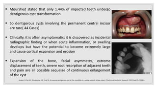  Mourshed stated that only 1.44% of impacted teeth undergo
dentigerous cyst transformation
 So dentigerous cysts involving the permanent central incisor
are rare( 44 Cases)
 Clinically, it is often asymptomatic; it is discovered as incidental
radiographic finding or when acute inflammation, or swelling
develops but have the potential to become extremely large
and cause cortical expansion and erosion
 Expansion of the bone, facial asymmetry, extreme
displacement of teeth, severe root resorption of adjacent teeth
and pain are all possible sequelae of continuous enlargement
of the cyst
Arakeri G, Rai KK, Shivakumar HR, Khaji SI. A massive dentigerous cyst of the mandible in a young patient: a case report. Plastic and Aesthetic Research. 2015 Sep 15;2:294-8.
 