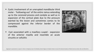  Cystic involvement of an unerupted mandibular third
molar - ‘hollowing-out’ of the entire ramus extending
up to the coronoid process and condyle as well as in
expansion of the cortical plate due to the pressure
exerted by the lesion and sometimes comes to lie
compressed against the inferior border of the
mandible.
 Cyst associated with a maxillary cuspid - expansion
of the anterior maxilla and resemble an acute
sinusitis or cellulitis
Nagarajan N, Jayachandran S, Jayaram V, Nisha A. Dentigerous Cyst in the Maxillary Anterior Region of a Pediatric Patient. Annals of the National Academy of Medical Sciences (India). 2021 Jan;57(01):58-61.
 