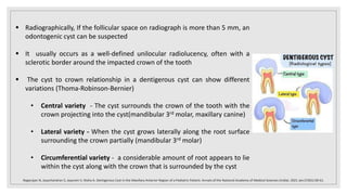  Radiographically, If the follicular space on radiograph is more than 5 mm, an
odontogenic cyst can be suspected
 It usually occurs as a well-defined unilocular radiolucency, often with a
sclerotic border around the impacted crown of the tooth
 The cyst to crown relationship in a dentigerous cyst can show different
variations (Thoma-Robinson-Bernier)
• Central variety - The cyst surrounds the crown of the tooth with the
crown projecting into the cyst(mandibular 3rd molar, maxillary canine)
• Lateral variety - When the cyst grows laterally along the root surface
surrounding the crown partially (mandibular 3rd molar)
• Circumferential variety - a considerable amount of root appears to lie
within the cyst along with the crown that is surrounded by the cyst
Nagarajan N, Jayachandran S, Jayaram V, Nisha A. Dentigerous Cyst in the Maxillary Anterior Region of a Pediatric Patient. Annals of the National Academy of Medical Sciences (India). 2021 Jan;57(01):58-61.
 