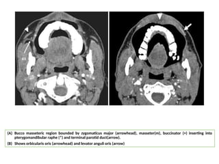 (A) Bucco masseteric region bounded by zygomaticus major (arrowhead), masseter(m), buccinator (+) inserting into
pterygomandibular raphe (*) and terminal parotid duct(arrow).
(B) Shows orbicularis oris (arrowhead) and levator anguli oris (arrow)
 