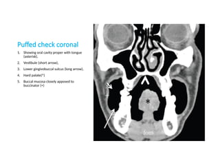 Puffed check coronal
1. Showing oral cavity proper with tongue
(asterisk),
2. Vestibule (short arrow),
3. Lower gingivobuccal sulcus (long arrow),
4. Hard palate(^)
5. Buccal mucosa closely apposed to
buccinator (+)
 
