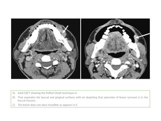 A) Axial CECT showing the Puffed Cheek technique in
B) That separates the buccal and gingival surfaces with air depicting that epicenter of lesion (arrows) is in the
buccal mucosa .
C) The lesion does not abut mandible as appears in A
 