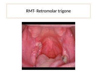 RMT- Retromolar trigone
 
