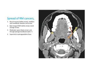 Spread of RM cancers,
1. Buccal mucosa (yellow arrow), maxillary
and mandibular alveolus (red arrow)
2. Base tongue/FOM (white arrow), tonsil
(orange arrow),
3. Masticator space (black arrow), and
through pterygomandibularraphe (*)
4. Superiorly to pterygopalatine fossa
 