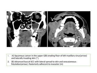 1. (A) Squamous cancer in the upper GBS eroding floor of left maxillary sinus(arrow)
and laterally invading skin (*).
2. (B) Advanced buccal SCC with lateral spread to skin and orocutaneous
fistulation(arrow). Posteriorly adherent to masseter (m)
 