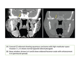 (A) Coronal CT reformat showing squamous carcinoma with high masticator space
invasion (*), (+) shows normal opposite lateral pterygoid.
(B) Bone window. Arrows in A and B show widened foramen ovale with enhancement
in A (perineural spread)
 