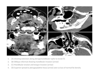 1. (A) showing extension along pterygomandibular raphe to tonsil (T)
2. (B) Oblique reformat showing mandibular invasion (arrow)
3. (C) Mandibular erosion and tongue invasion (arrow)
4. (D) Superior spread to pterygopalatine fossa (arrow) seen as loss of normal fat density
 