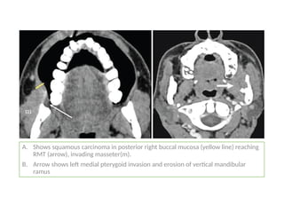 A. Shows squamous carcinoma in posterior right buccal mucosa (yellow line) reaching
RMT (arrow), invading masseter(m).
B. Arrow shows left medial pterygoid invasion and erosion of vertical mandibular
ramus
 