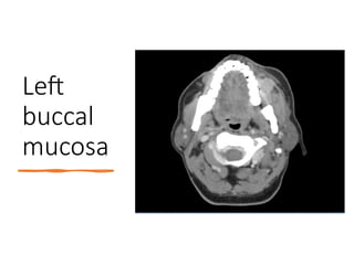 Left
buccal
mucosa
 