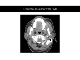 Lt buccal mucosa with RMT
 