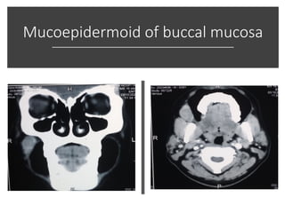 Mucoepidermoid of buccal mucosa
 