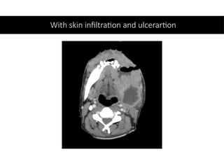 With skin infiltration and ulcerartion
 