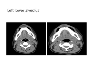 Left lower alveolus
 