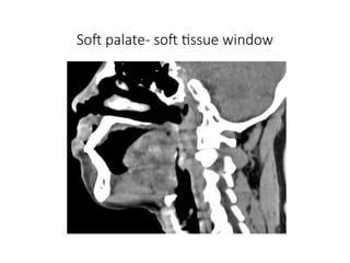 Soft palate- soft tissue window
 
