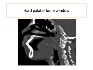 Hard palate- bone window
 