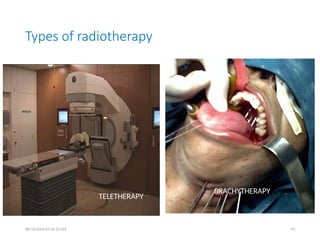 Types of radiotherapy
08/13/2026 01:42:12 AM 94
TELETHERAPY
BRACHYTHERAPY
 