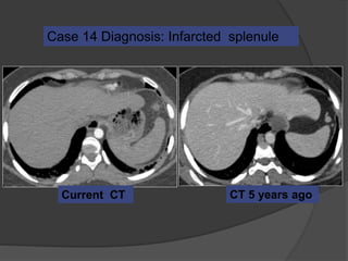 CT 5 years agoCurrent CT
Case 14 Diagnosis: Infarcted splenule
 