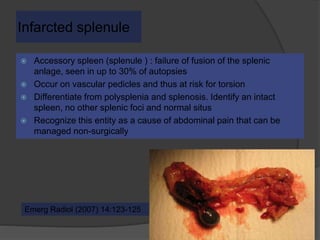 Infarcted splenule
 Accessory spleen (splenule ) : failure of fusion of the splenic
anlage, seen in up to 30% of autopsies
 Occur on vascular pedicles and thus at risk for torsion
 Differentiate from polysplenia and splenosis. Identify an intact
spleen, no other splenic foci and normal situs
 Recognize this entity as a cause of abdominal pain that can be
managed non-surgically
Emerg Radiol (2007) 14:123-125
 