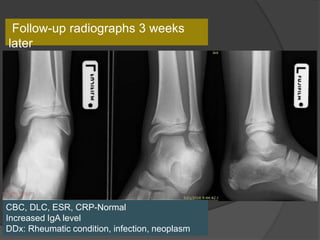 Follow-up radiographs 3 weeks
later
CBC, DLC, ESR, CRP-Normal
Increased IgA level
DDx: Rheumatic condition, infection, neoplasm
 