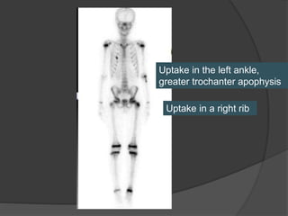 Uptake in the left ankle,
greater trochanter apophysis
Uptake in a right rib
 